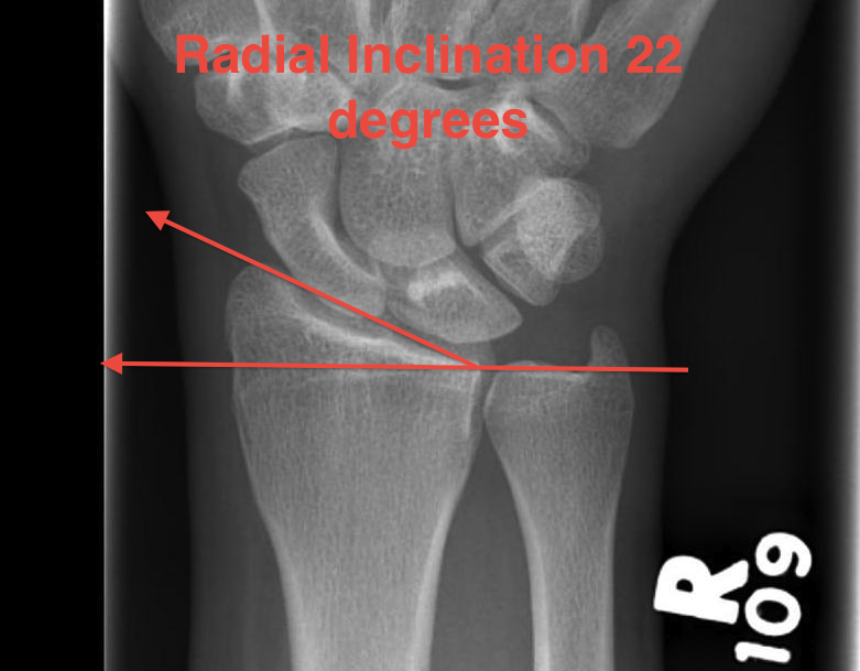 Normal Radial Inclination